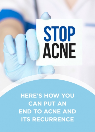 Here’s how you can put an end to acne and its recurrence