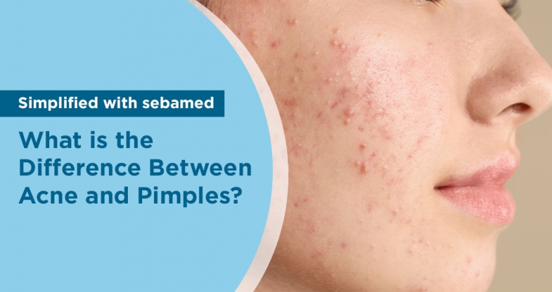 Girl with acne on her face