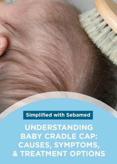 Understanding Baby Cradle Cap: Causes, Symptoms, and Treatment Options