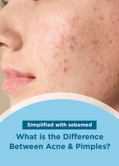 What is the Difference Between Acne and Pimples?